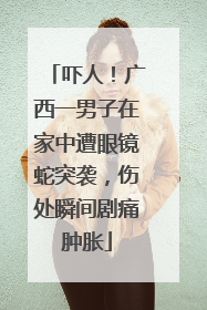吓人！广西一男子在家中遭眼镜蛇突袭，伤处瞬间剧痛肿胀